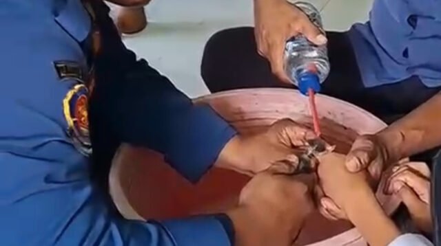 Proses evakuasi cincin yang tersangkut di jari korban.