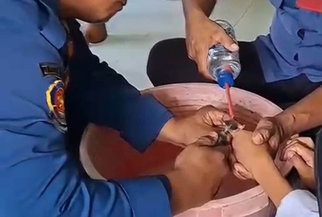 Proses evakuasi cincin yang tersangkut di jari korban.